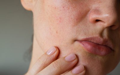 Everything You Need To Know About Rosacea